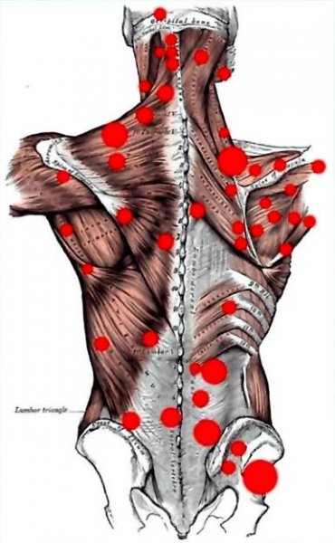 trigger points