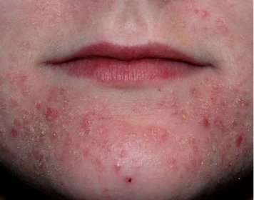 Jak se projevuje dermatitida?