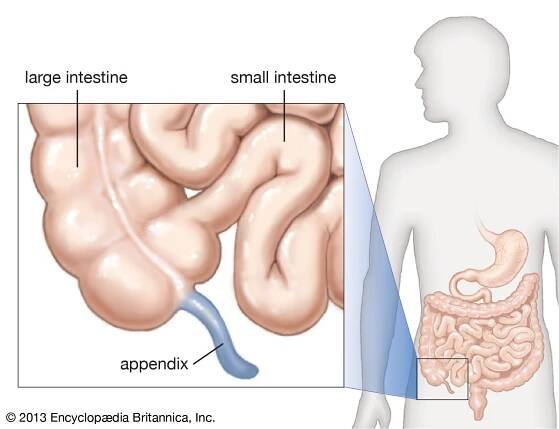 Appendicitis