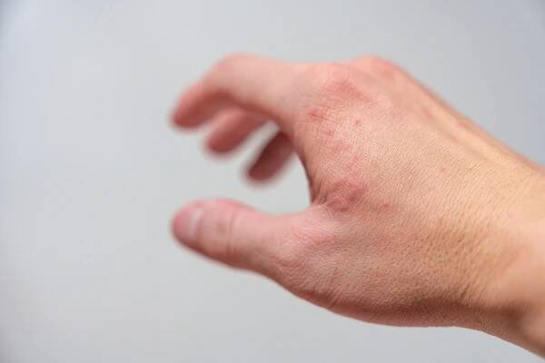 Alergická reakce, červená vyrážka po ruce způsobená počasím nebo houbami — Stock obrázek