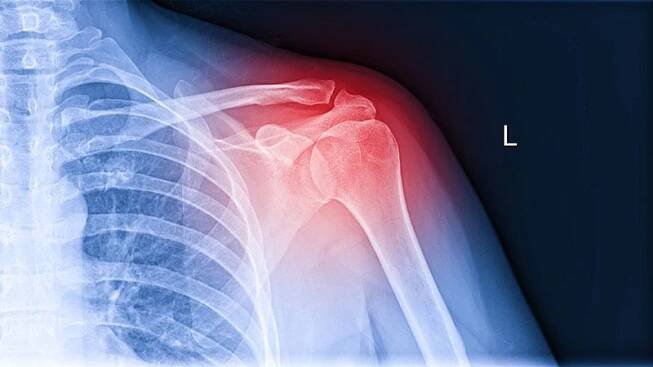 Proximal Humerus Fracture Patients Face High Mortality Rates