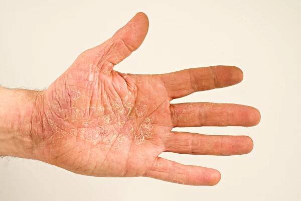 li. Hand 831 Neurodermitis
