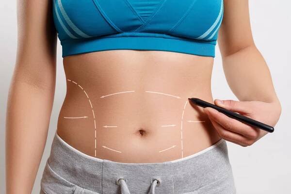 Scars After Tummy Tuck