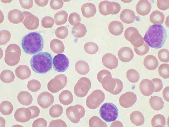 Chronická lymfocytární leukémie (CLL) – příznaky, příčiny a léčba