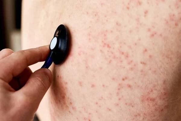 Alergická vyrážka na kůži. Žena s dermatologickým problémem na zadní kůži — Stock obrázek