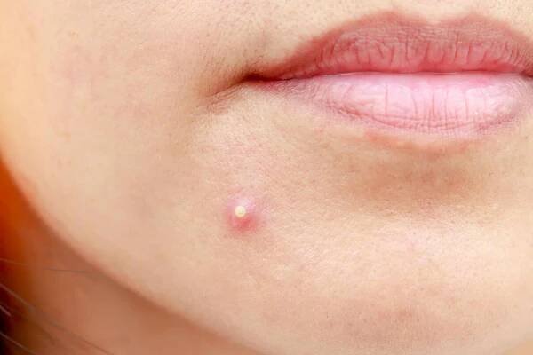 6 Steps To Heal A Stubborn Pimple