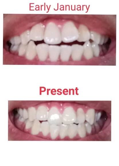 Mewing improved teeth and bite - before and after photos