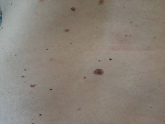 Den melanomu opět odhalil závažná onemocnění kůže
