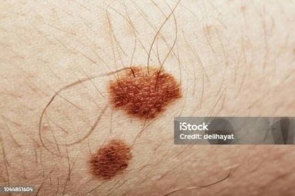 Stock fotografie Obří Kožní Krtek – stáhnout obrázek nyní - Melanom - Rakovina kůže, Biopsie, Celý snímek