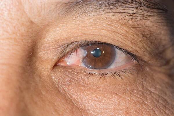 How Do I Know if I Have a Pterygium? - Ventura County Lasik
