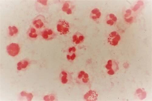 Gonorrhea - Wikipedia