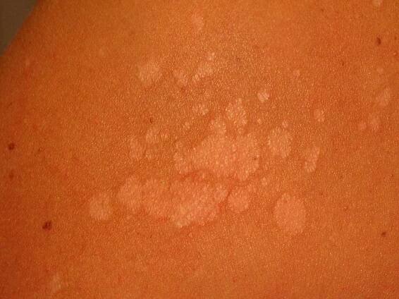 Tinea versicolor rash (itchy for some people)