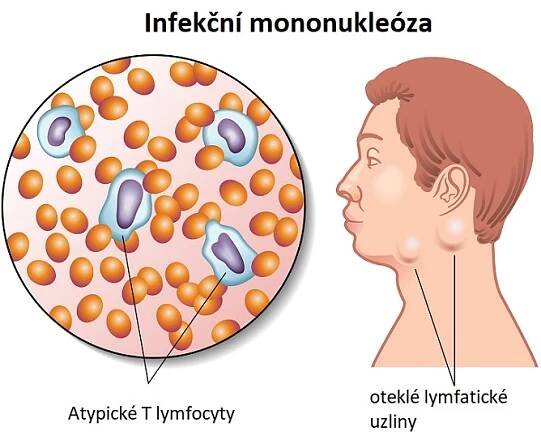 Infekční mononukleóza neboli nemoc z líbání - příznaky, léčba a jídelníček