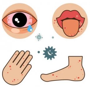 onemocnění rukou - nemoc rukou nohou a úst stock ilustrace