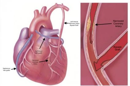 coronary_artery_bypass_surgery