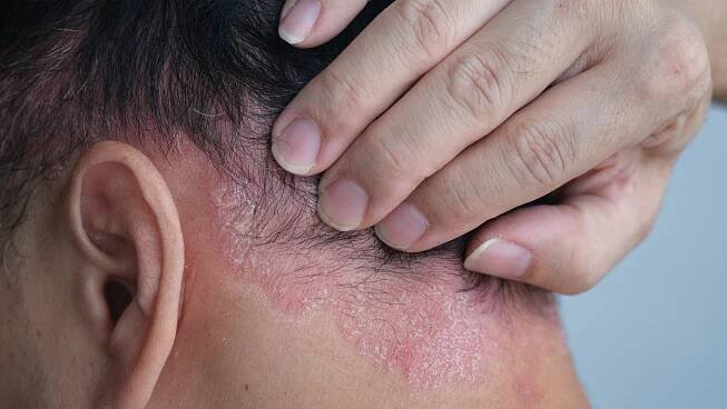 Seboroická dermatitida a její příčiny, projevy a možnosti léčby - léčit.cz