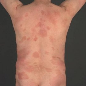 Mycosis fungoides