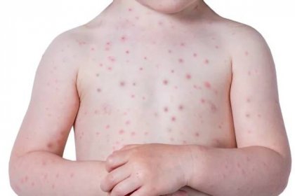 Jak poznáte plané neštovice? Děti nejsou jediné, kdo onemocní