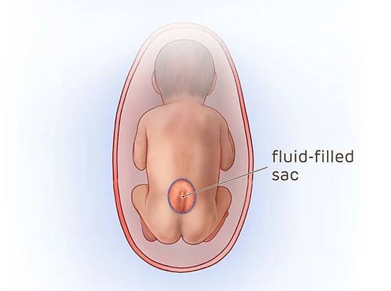 Fetal surgery for spina bifida (myelomeningocele, MMC) | Children's Hospital of Philadelphia