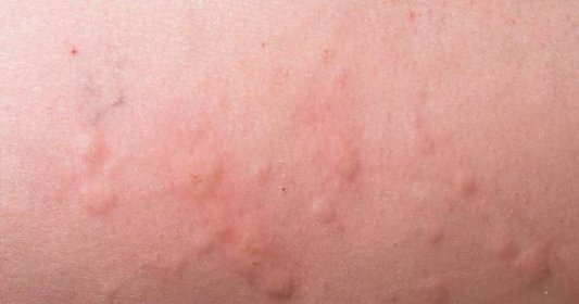 alergicka-vyrazka-koprivka