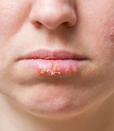 What Are Cold Sores
