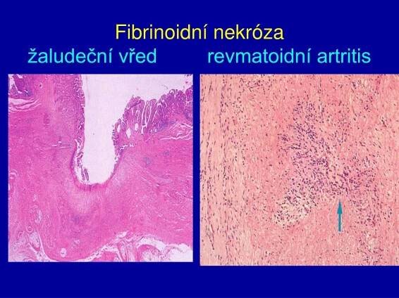PPT - Nekrózy, gangrény PowerPoint Presentation, free download - ID:458546