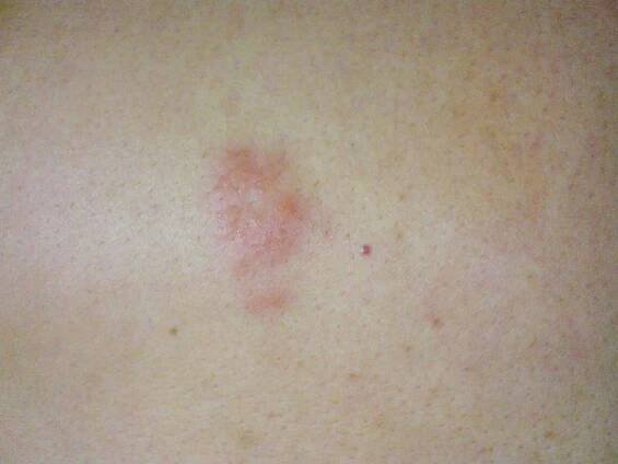 Herpes rash early