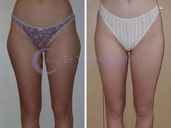Legs/Buttocks Liposculpture - Dr. Yuri Macrino - Chirurgo Plastico