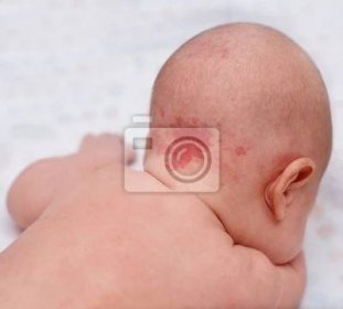 Hemangiom, benigní nádor na zádech hlavy u dítěte. - Plakáty - myloview