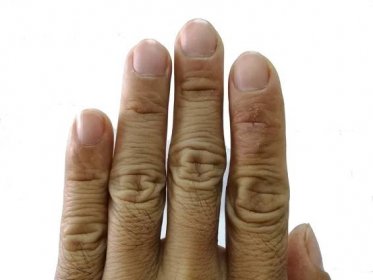 Oteklé ruce i lesklá pokožka značí vážnou nemoc. Zbystřit by měly hlavně ženy