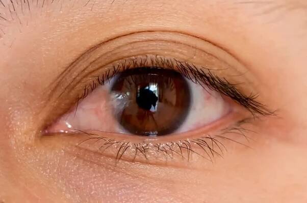 Pterygium Surgery - See Beyond Limits