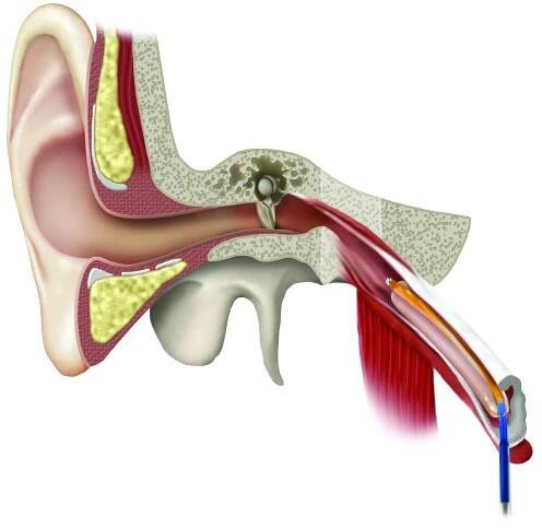 eustachian tube dysfunction