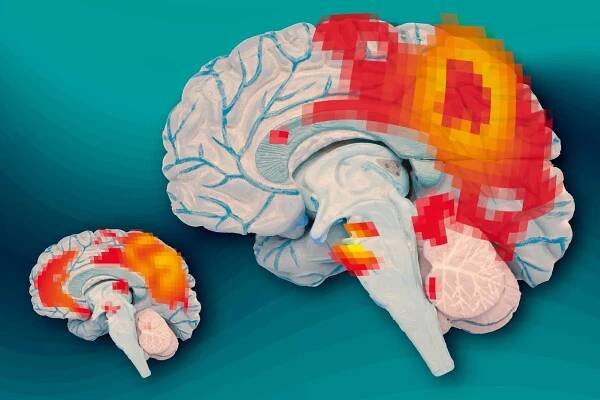 A cross-section of the human brain. The brain on the left shows an adult no longer suffering from ADHD while the brain on the right is someone is an adult suffering from ADHD symptoms.