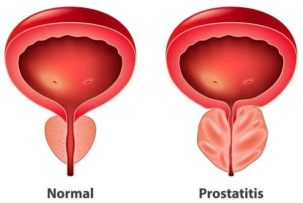 Urologist Singapore