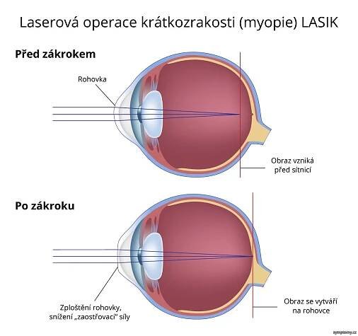 Laserová operace očí – LASIK - příznaky a léčba