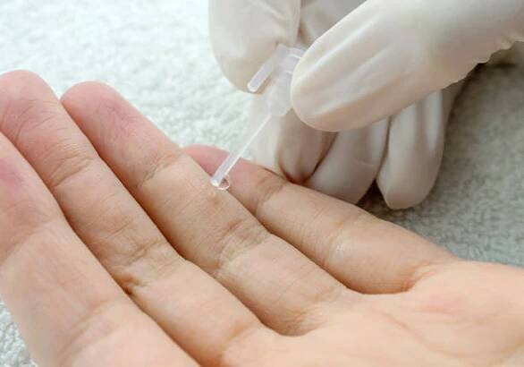 dermatolog používá léčbu k odstranění bradavice na ženském prstu. verruca vulgaris. selektivní zaostření, detailní. - bradavicím na chodidle - stock snímky, obrázky a fotky