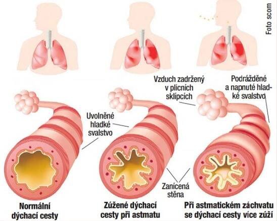 Pravdy a mýty o kortikoidech: Proč se nebát hormonů?