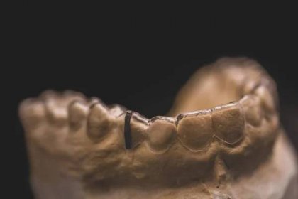 Jasné zarovnání nebo držák na zuby pro ortodontické pacienty na modelu — Stock obrázek