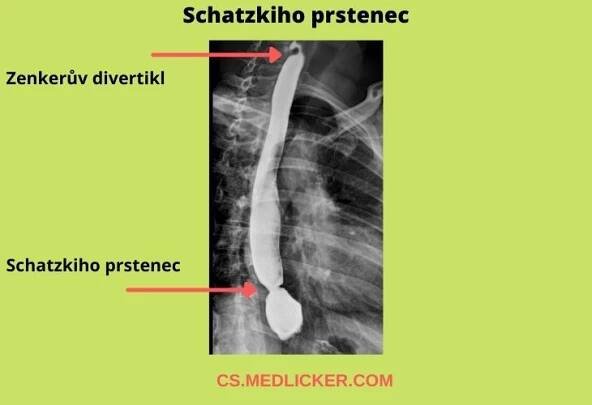 Schatzkiho prstenec je symptomatické zúžení gastroezofageální junkce, které se projevuje příznaky, jako jsou bolest při polykání nebo váznutí tuhé potravy v distálním jícnu