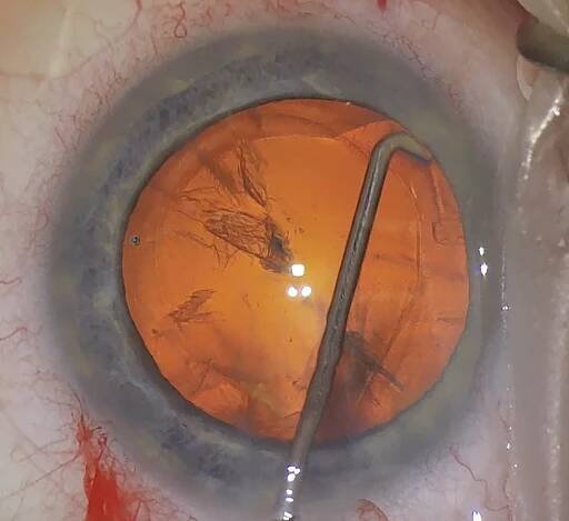 Cataract surgery steps