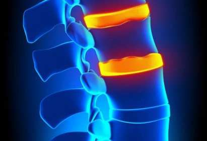 Bulging/Herniated disc Archives - Spinal Backrack