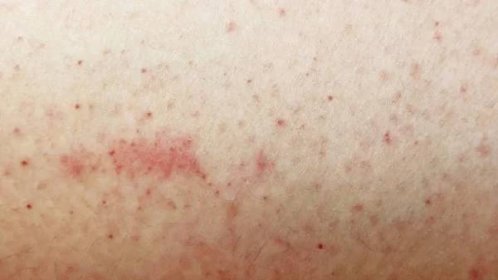 Vyrážka na citlivou kůži nebo kožní problémy s alergii vyrážka — Stock obrázek