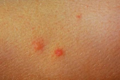 Detailní záběr komor kousne do kůže. Alergická reakce. Zánět kůže. Nemoci a léčba kožních onemocnění — Stock obrázek