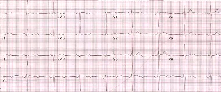 ECG second degree av block, ratio 2:1, narrow qrs