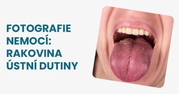 Rakovina ústní dutiny foto: Jak může nemoc ve skutečnosti vypadat?