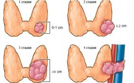 Fáze rakoviny štítné žlázy