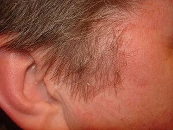 Chronická dermatóza pokožky hlavy, jak rozlišovat a jak se léčit / Články | Užitečné informace a tipy na péči o sebe. Zdraví