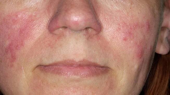 Rosacea je léčitelný problém, který ničí sebevědomí