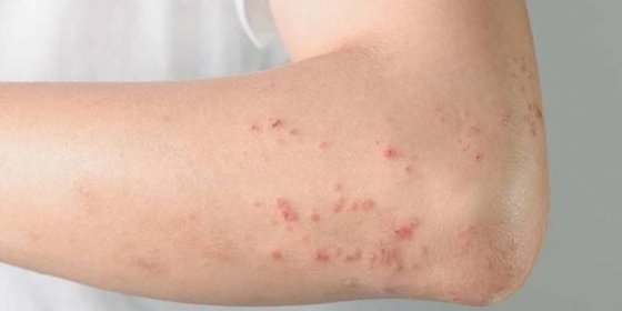 Alergická kopřivka na kůži rukou