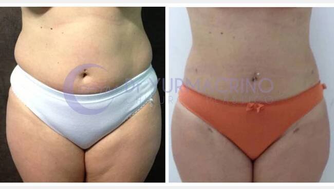 Abdomen/Hips Liposculpture - Dr. Yuri Macrino - Chirurgo Plastico